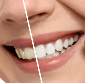 Teeth Whitening Teeth Whitening
